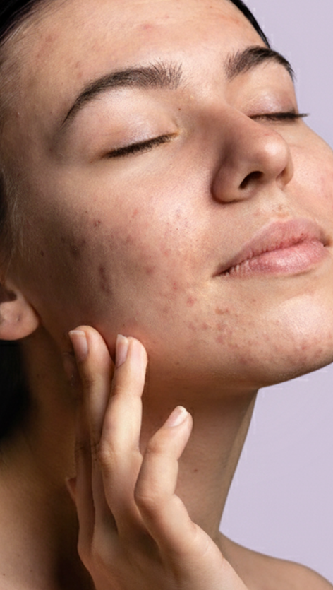 ACNE PRONE SKIN